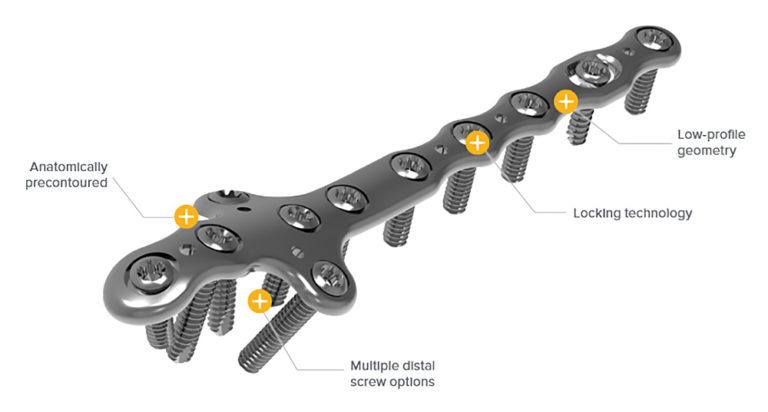 Ankle Plating System – Ortho Medics