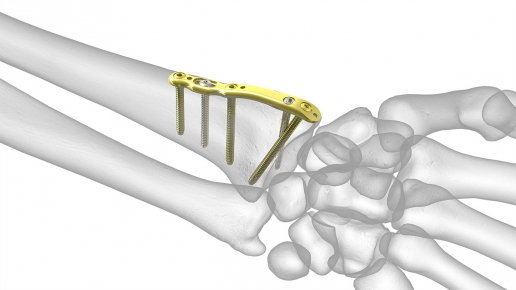 Acu Loc Wrist Plating System Ortho Medics