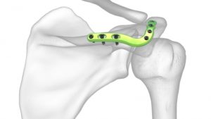 Scapula Plating System – Ortho Medics